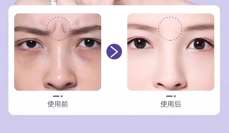 川字纹贴告别皱纹紧致提拉改善淡化法令纹眼角纹舒展皱纹美容贴 6